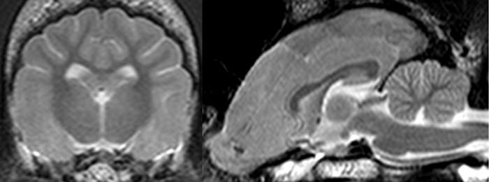 idiopatische Epilepsie